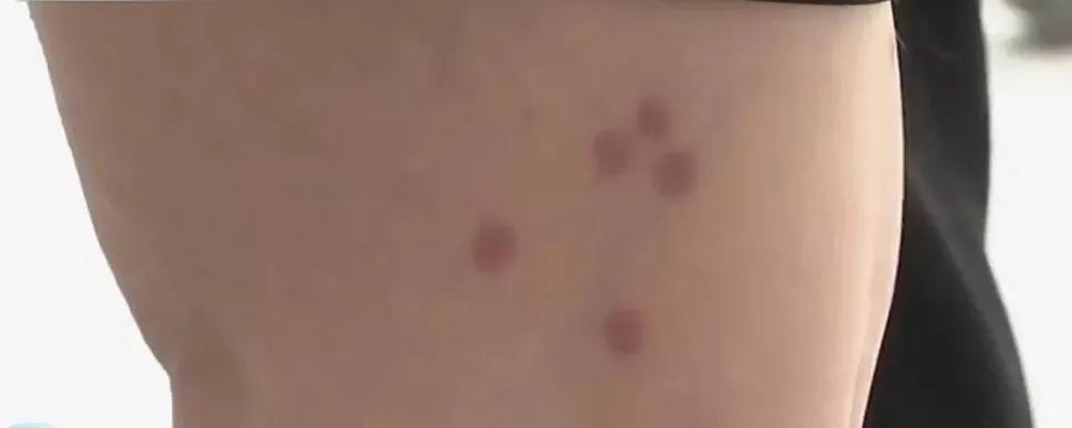 当心！假期出游警惕身体出现这样的小红点，严重或可致命