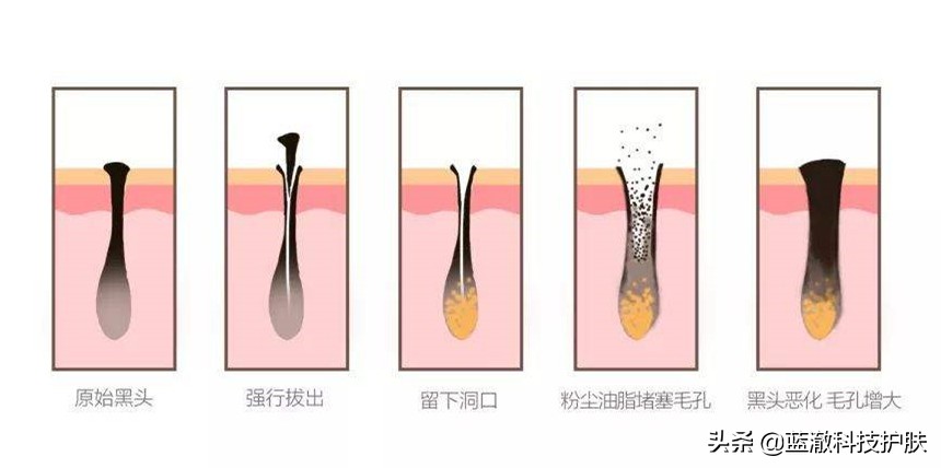 黑头太顽固教你去黑头的方法,去黑头的小窍门视频