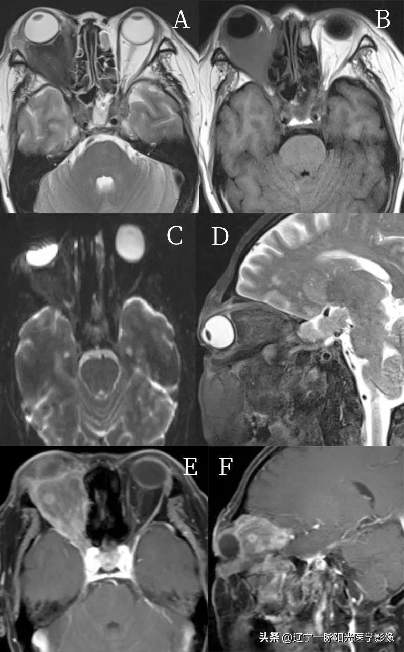 眼部肿瘤治疗有哪些,眼部肿瘤症状有哪些