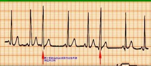 心脏早搏是什么原因怎么治,心脏早搏是怎么引起的原因有哪些