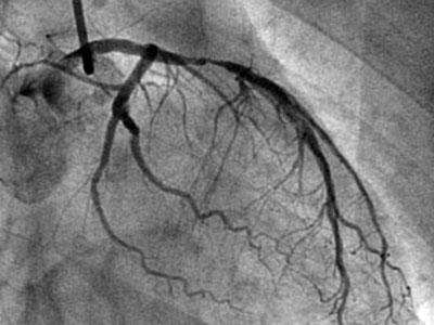 心血管狭窄40%不吃药行吗,心血管狭窄99%不放支架