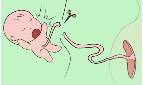 脐带异常为啥引起窒息,脐带过度螺旋呈麻花状