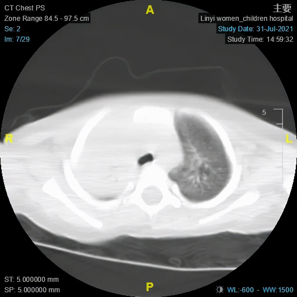 肺炎支气管镜一般费用多少,肺炎不好反复发烧