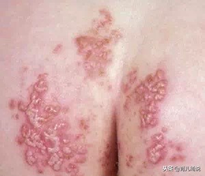 宝宝红屁股看着好心疼!戳这里,给你最全有效的红屁股治疗方法