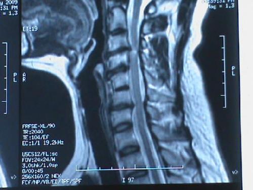 什么人不能用颈椎牵引器,哪些人不适合做牵引