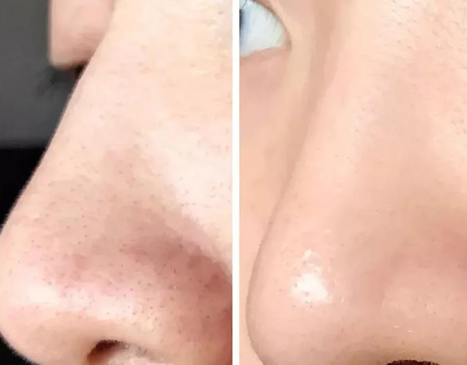 修复面膜贴上有刺痛感,面膜敷起来有刺痛感是好还是不好