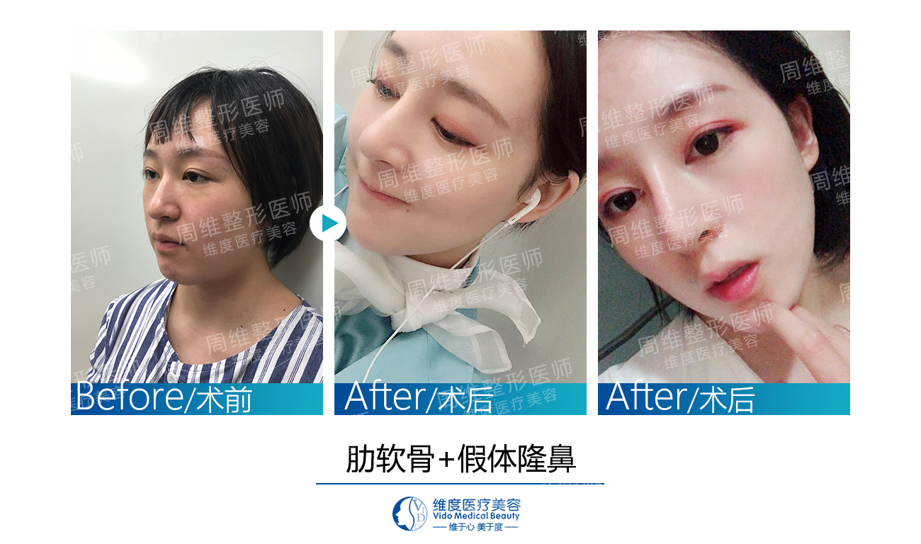 隆鼻土耳其糖块,土耳其软糖隆鼻鼻尖会显形吗