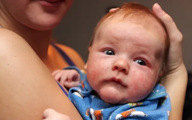 宝宝湿疹哺乳妈妈有必要忌口吗,宝宝湿疹都是妈妈的错