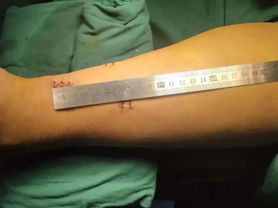 跟腱炎是跟腱断裂的前兆吗,预防跟腱断裂的几个征兆