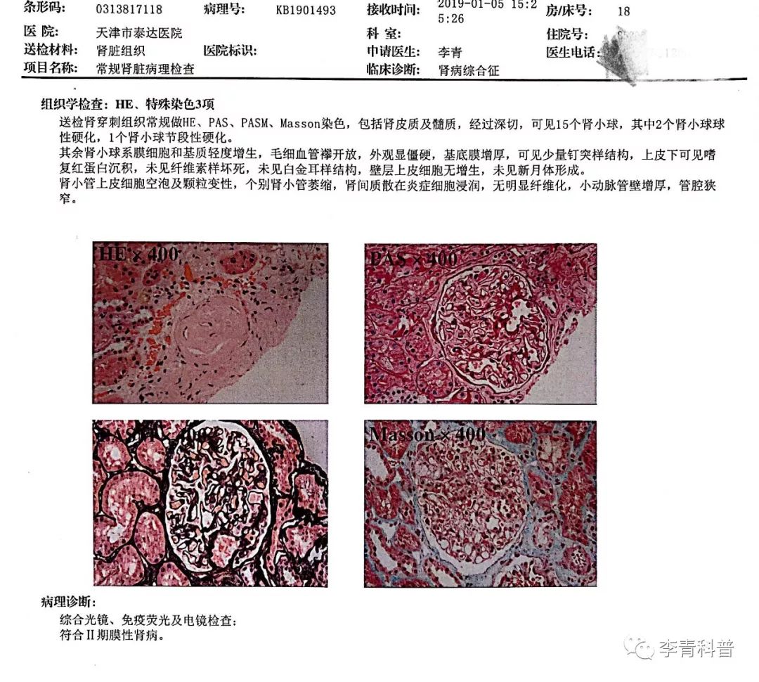 糖尿病大量蛋白尿，为何还要用激素治疗？医生终于讲出实情！
