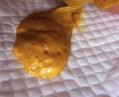 婴儿拉绿便的几种形状,宝宝拉绿便怎么鉴别