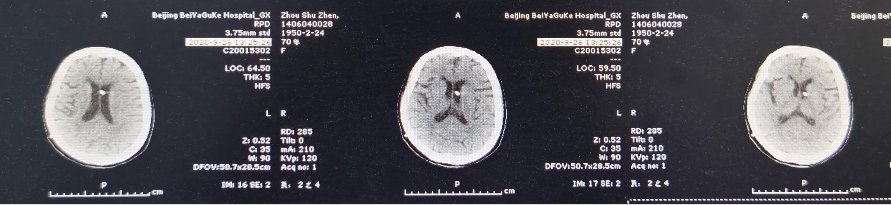 颈椎术后脑脊液漏取什么体位,脊髓型颈椎病手术后植骨愈合时间