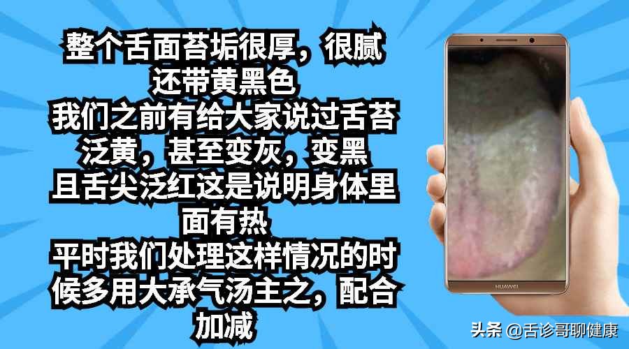 舌诊哥聊健康痰湿,抖音舌诊哥舌象分析与感悟