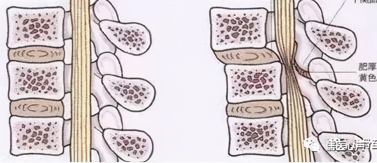 腰痛捉妖记（二十三）------没有受伤，我的腰椎怎么就滑脱了？