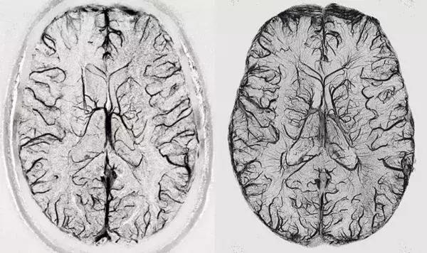 磁共振成像的最新研究,目前最先进的核磁共振仪