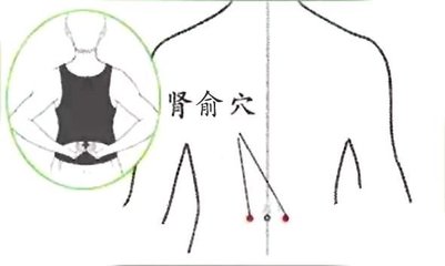 脚后跟干裂像鱼鳞是什么原因,脚后跟鱼鳞状干裂怎么刮