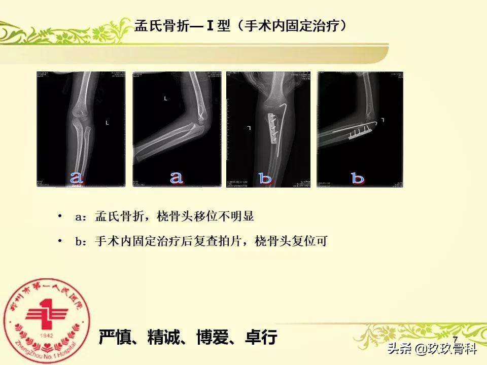 孟氏骨折功能训练多久能恢复正常,孟氏骨折中医能治吗