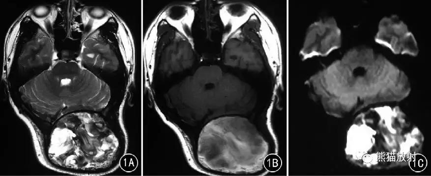 假性血友病什么症状,血友病病理