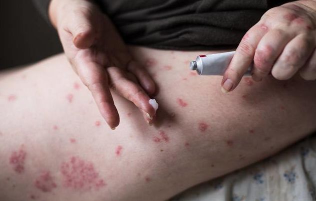 晚上湿疹瘙痒厉害怎么办用什么,孕妇湿疹晚上痒的睡不着怎么办