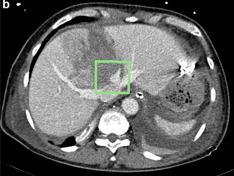 肝脏损伤的诊断和处理,肝脏损伤ii级
