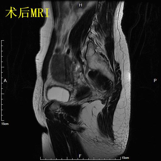 子宫肌瘤不能开刀只能化疗严重吗,子宫肌瘤介入栓塞治疗后注意事项