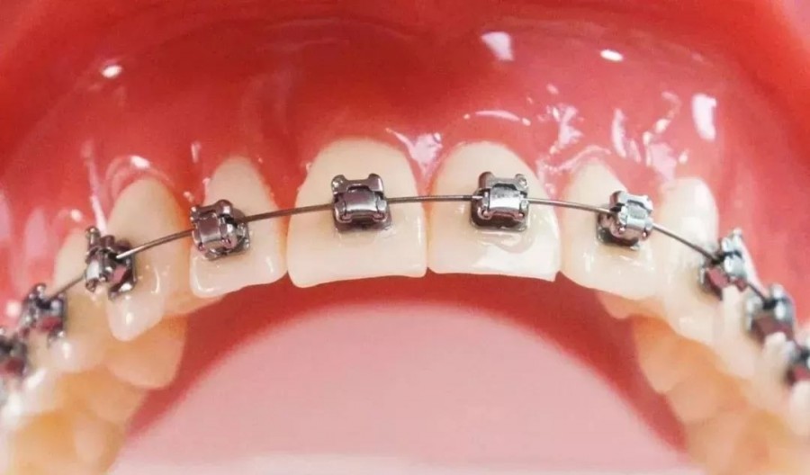 正畸价格会下降吗,正畸矫正为啥这么贵