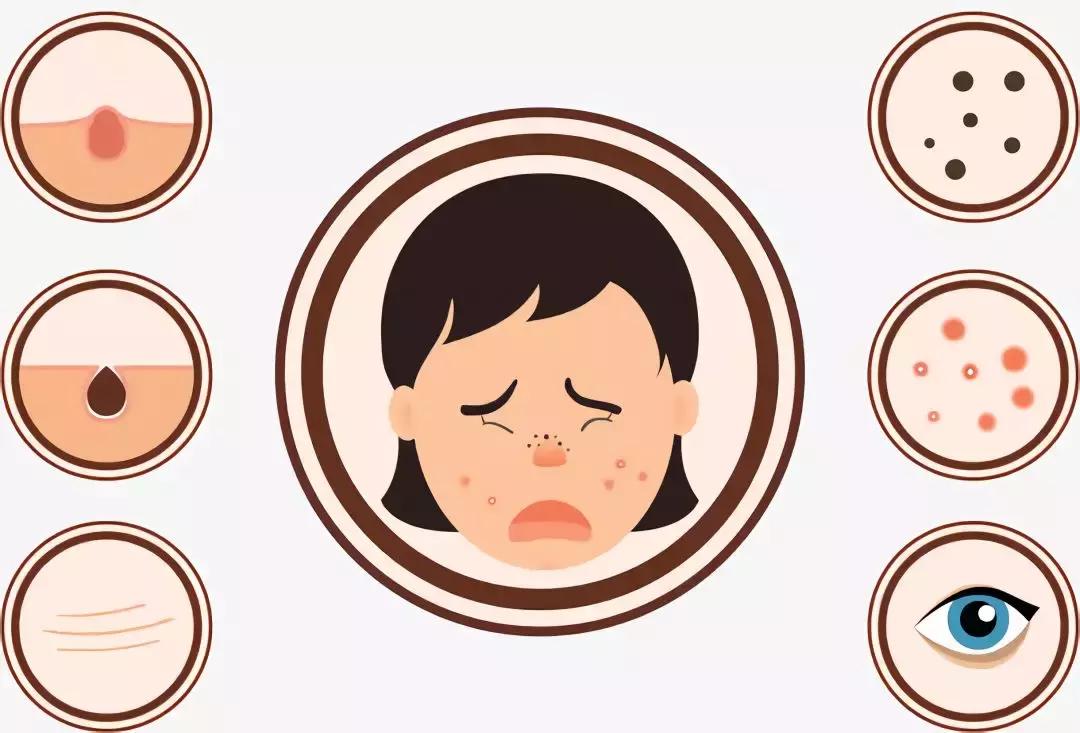 手把手教你正确挤痘不留坑,挤痘有个坑怎么补救