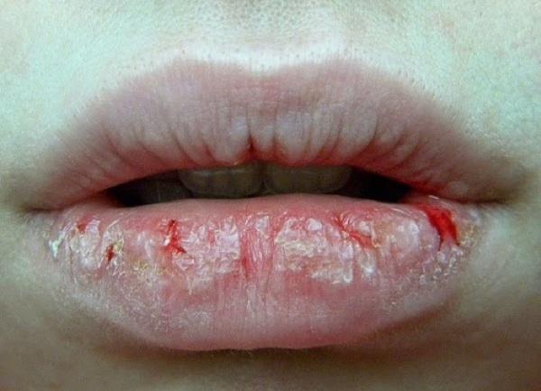 嘴唇干裂起皮怎么护理秒变嘟嘟唇,嘴唇干燥唇纹深你应该这么做