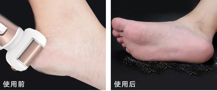 脚上老茧太厚了走路不舒服,脚上老茧不硬了发黄