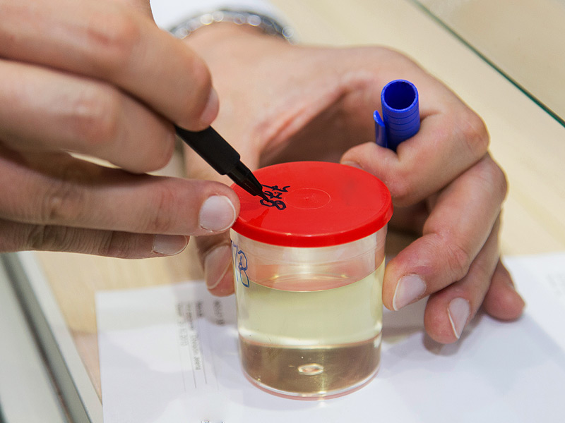 尿常规几项指标分别代表什么,尿常规肿瘤表现