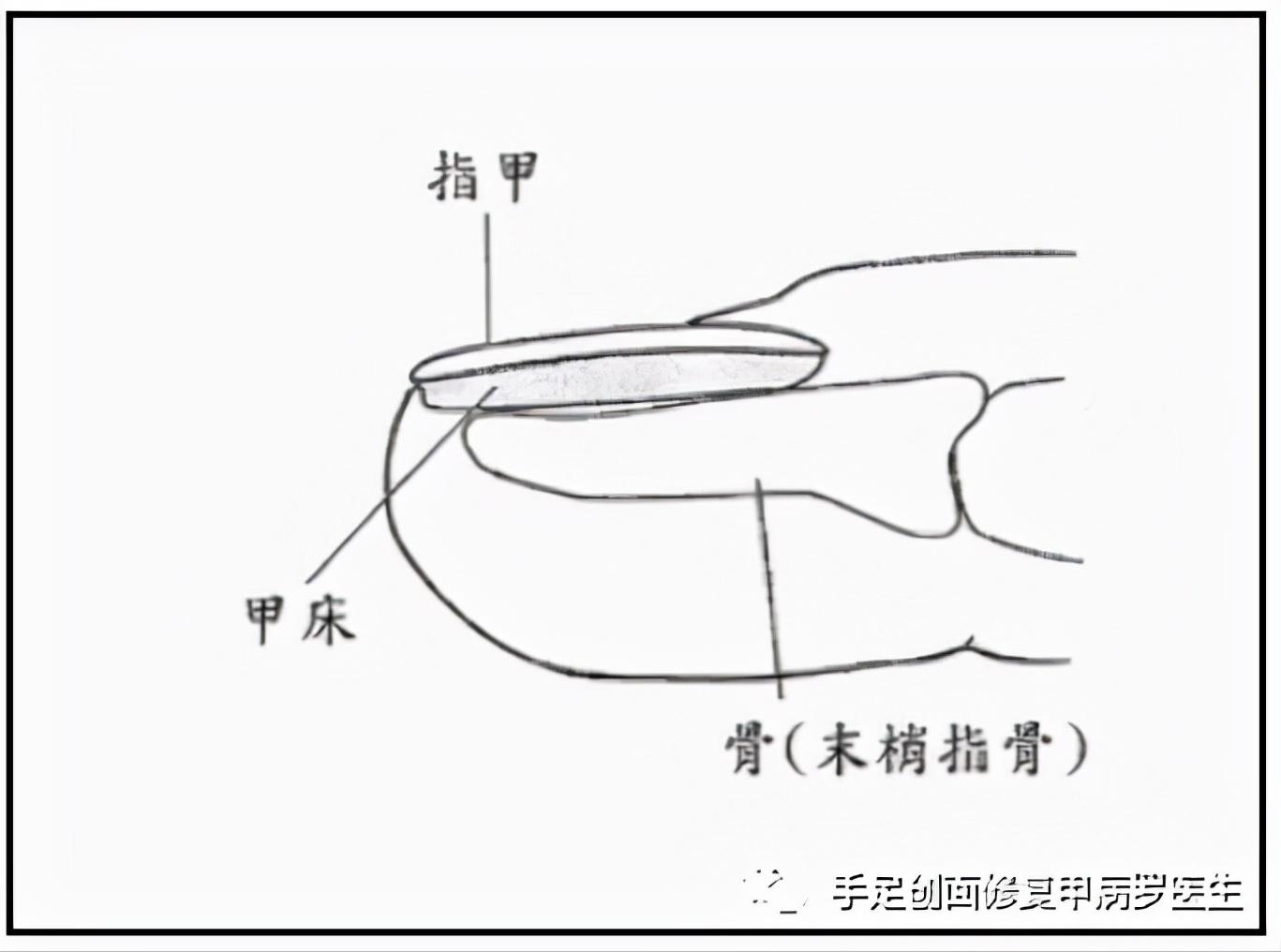 甲下积血放血后如何止血,甲下积血怎么办