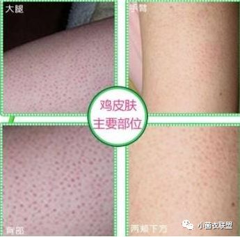 毛囊旁边长了小疙瘩不痛不痒,毛囊上肉疙瘩