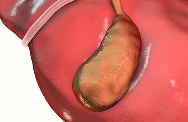 胆囊息肉是很常见的病吗,胆囊息肉9mmx7mm算严重需要手术吗