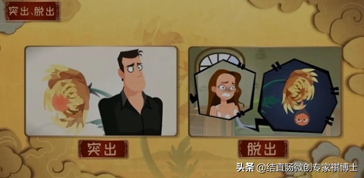 什么是混合痔疮的症状,得了痔疮会有哪些症状