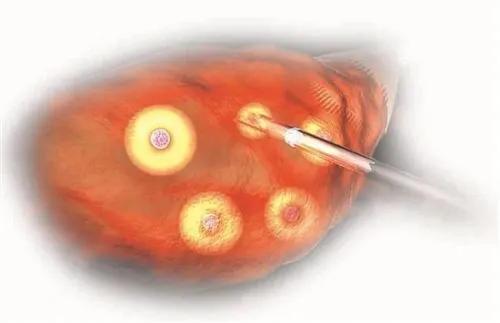 收藏！试管婴儿促排、取卵、移植期间的生活指南