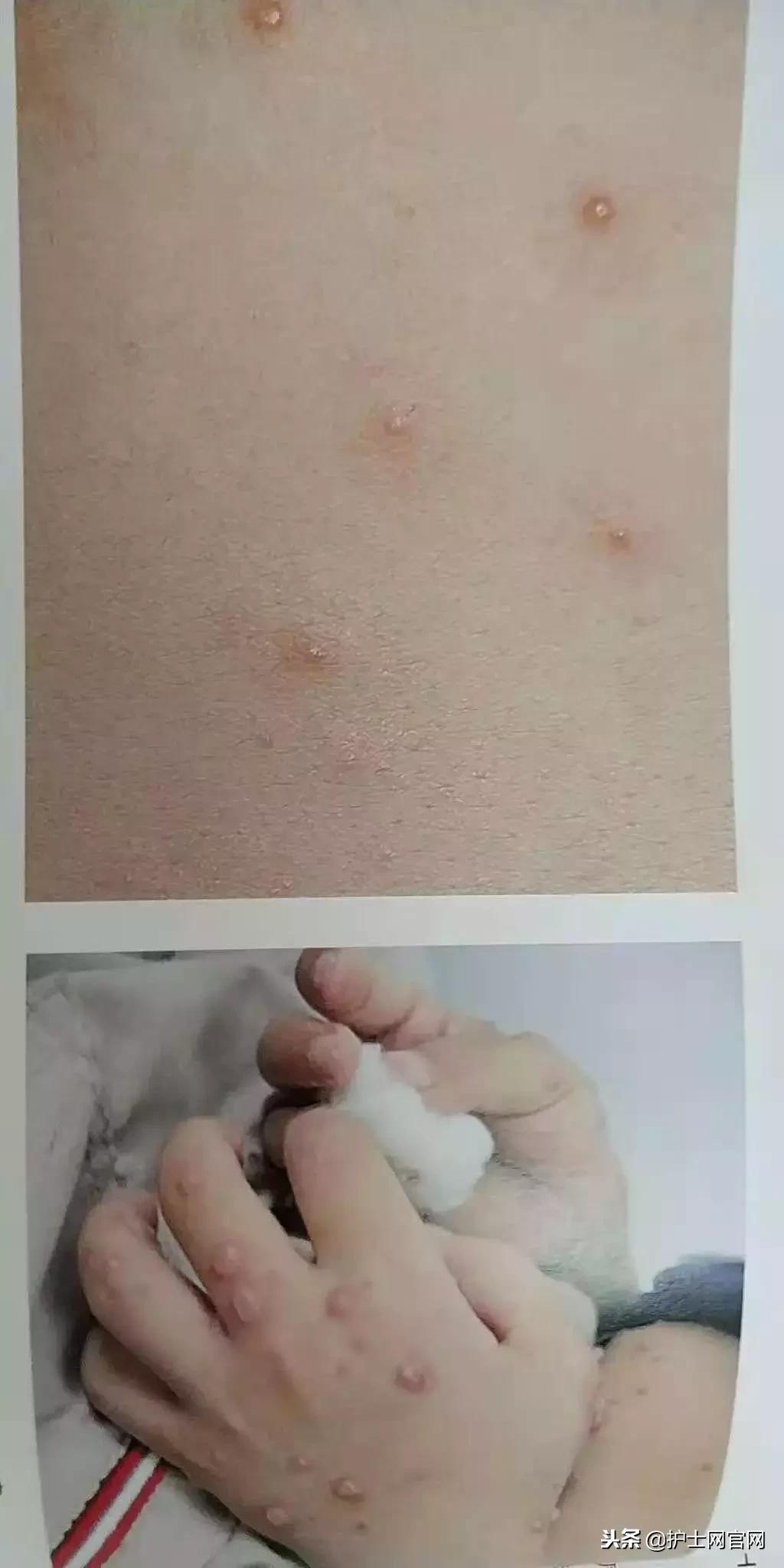 水痘病人的病房如何消毒,水痘患者应隔离至什么阶段