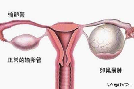 生理性卵巢囊肿是什么性质的,生理性卵巢囊肿是什么病