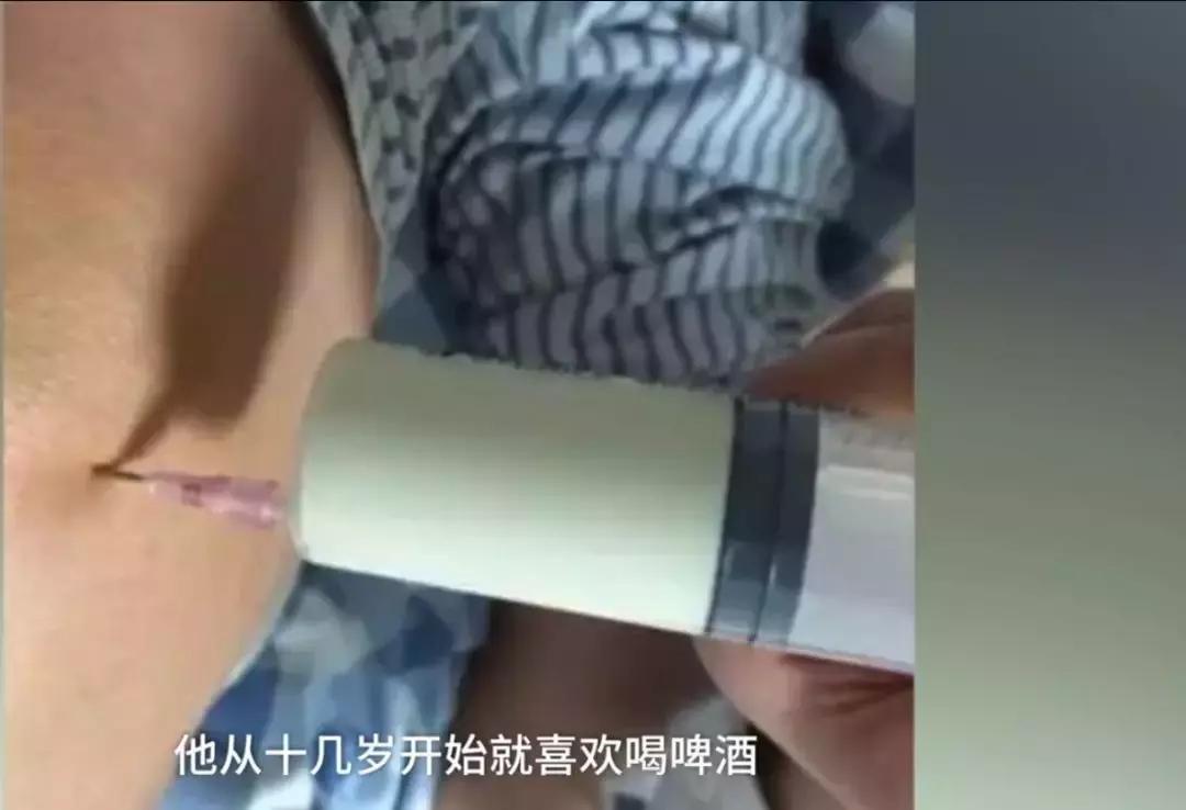 29岁男子患痛风：每天喝啤酒，膝盖抽出大量浑浊液体