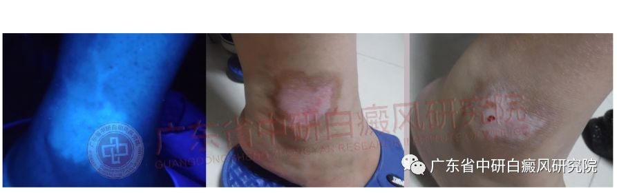 手指白癜风白斑变红是好转迹象吗,脚上白癜风308后发红是好转迹象吗