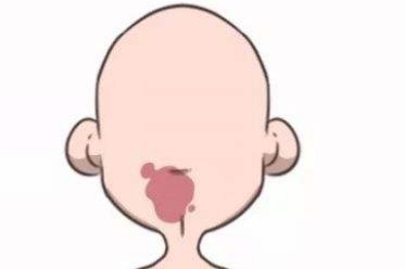 宝宝胎记的症状有哪些,宝宝出生有胎记是怎么来的