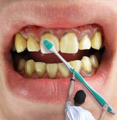 牙齿上的黄泥是什么,牙齿上的黄泥怎么去除