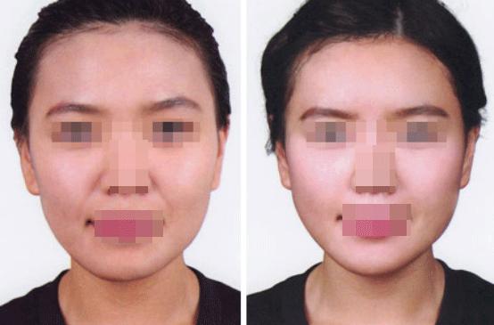 消除法令纹做什么项目,消除法令纹按什么穴