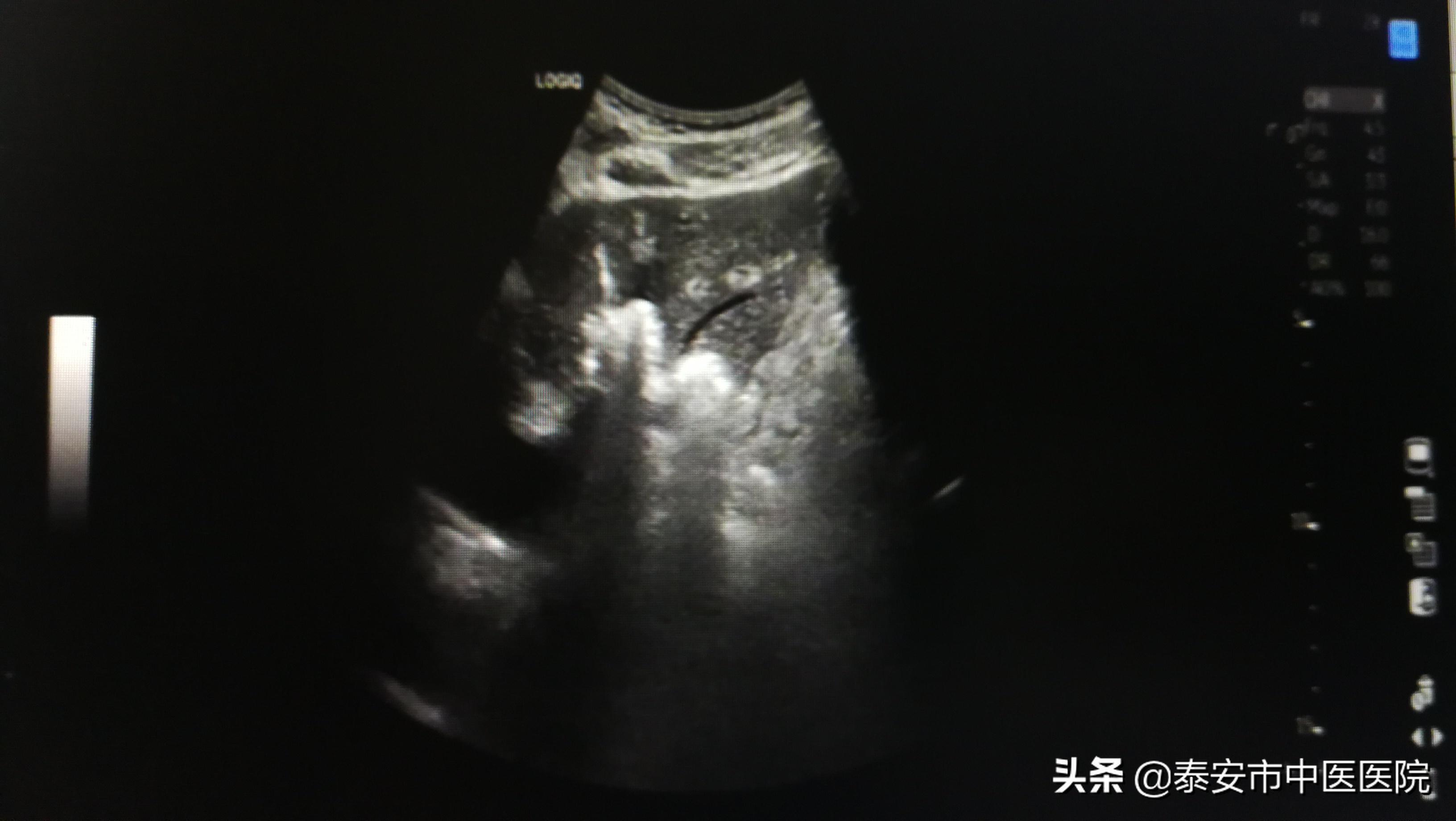 肝血管瘤射频消融术广东省中医院,射频消融治疗肝血管瘤需要住院吗