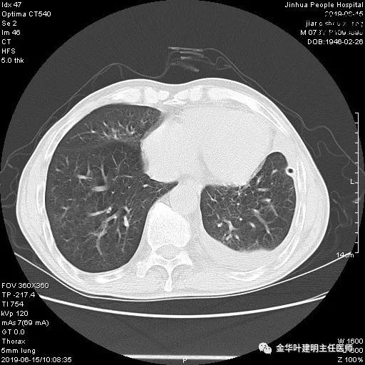肺手术后乳糜胸是医疗事故吗,肺部切除后乳糜胸治好了