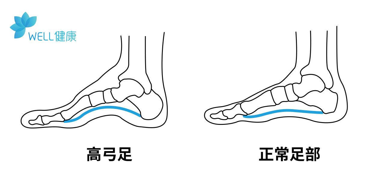 足弓塌陷会导致脚后跟疼吗,足弓和脚后跟痛怎么回事