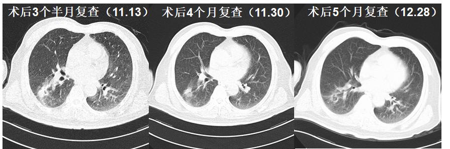 肺鳞癌介入治疗成功率,肺鳞癌最好的免疫化疗方案