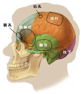 开颅手术的开颅是个什么样的操作,开颅手术最危险的是什么样情况