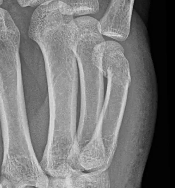 几种严重骨折医学名称,常见的骨折有哪些名称