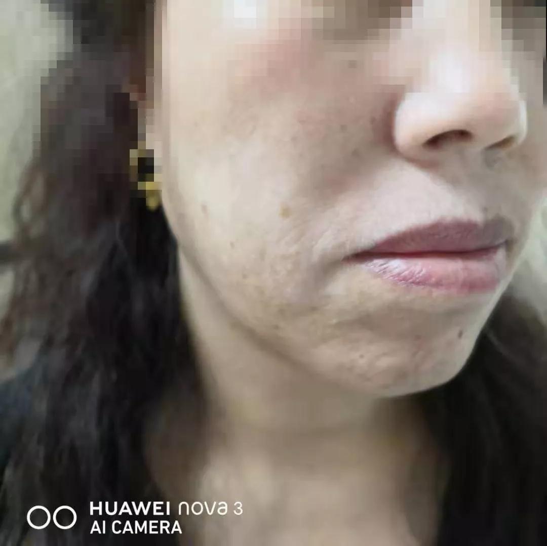 治疗白癜风中医好还是西医好,治疗白癜风中医好还是西医效果好