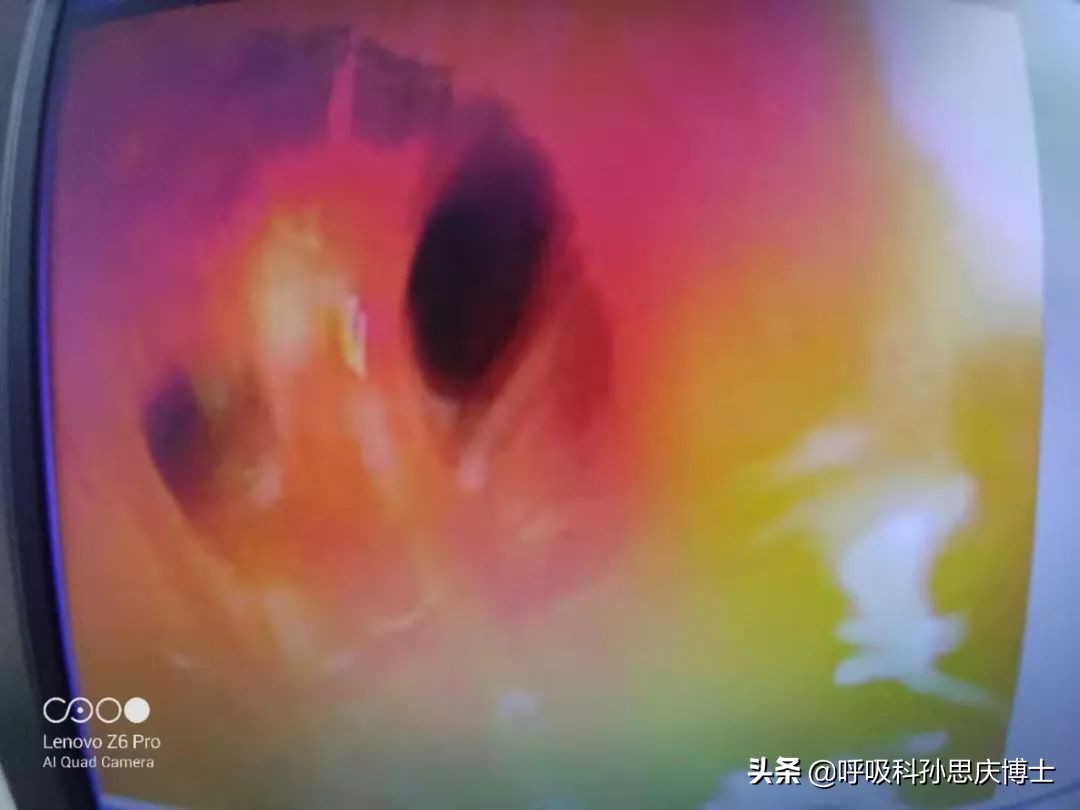 多年的肺炎不治疗会怎么样,为什么肺炎长期没有治愈